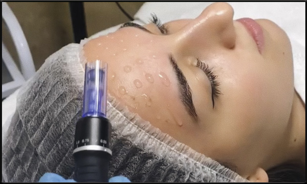 ZENA Microneedling ZENA Microneedling bei ck Kosmetik in Moers